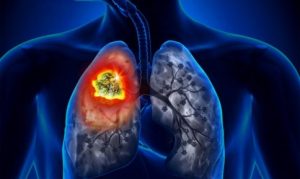 Không hút thuốc vẫn bị ung thư phổi –  Nguyên nhân là do đâu