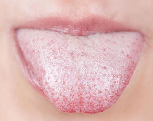 Mảng bám trắng trên lưỡi là dấu hiệu đầu tiên bạn cần đào thải độc tố trong cơ thể ngay hôm nay
